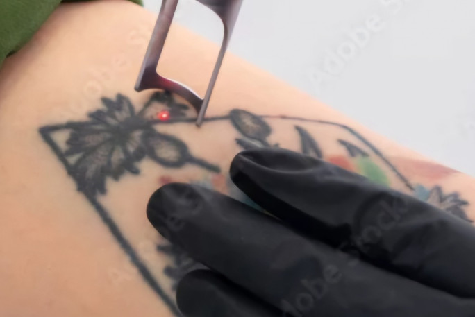 Tattoo Removals Business for Sale Ponsonby Tattoo Removals Business for Sale Ponsonby